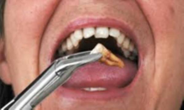 بهبودی بعد از کشیدن دندان