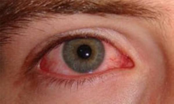التهاب ملتحمه (قرمزى چشم)