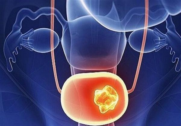 چرا دچار سنگ مثانه می شویم؟ چرا دچار سنگ مثانه می شویم؟